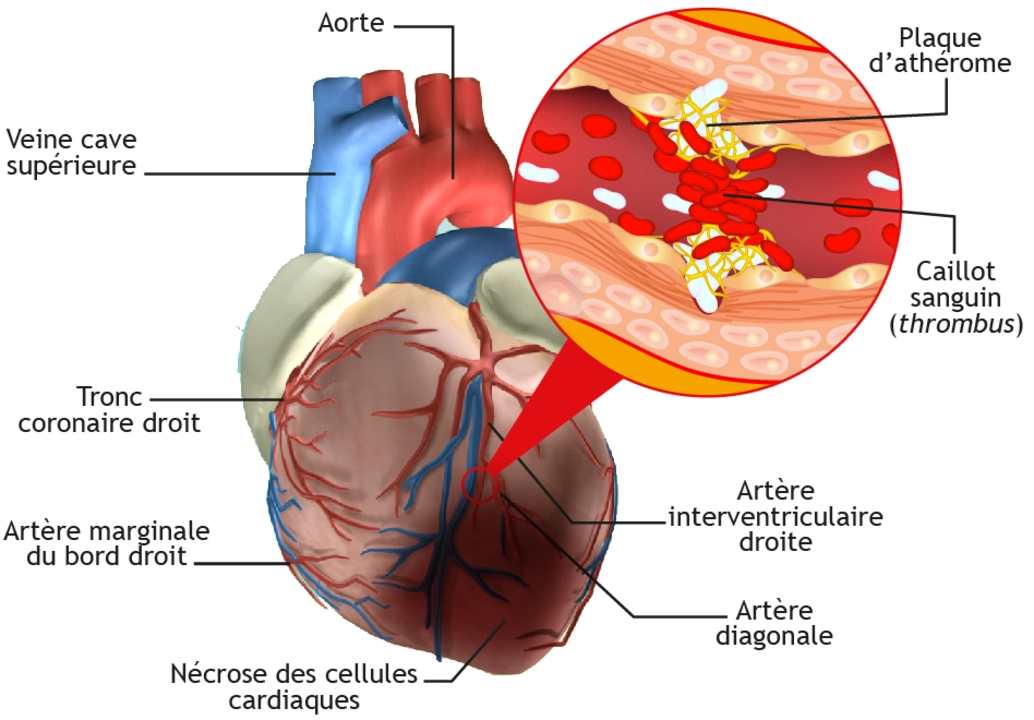 L'impact de l'hypertension artérielle sur la maladie des artères coronaires